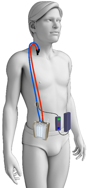 artificial lung